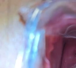 2 Clips // Spekulum in Nahaufnahme aus dem "Spekulum Live Meeting"